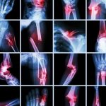 Bone cancer is widespread nowadays; know the symptoms of bone cancer.