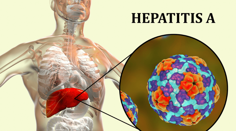 What is hepatitis A? Find out the symptoms and treatment of hepatitis A.